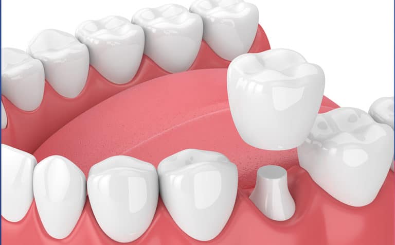 Dental crown being placed on prepared tooth