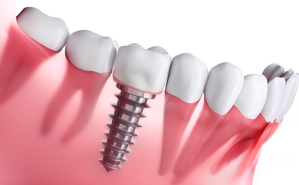 What are the Benefits of Getting Dental Implants in the River Oaks Area?