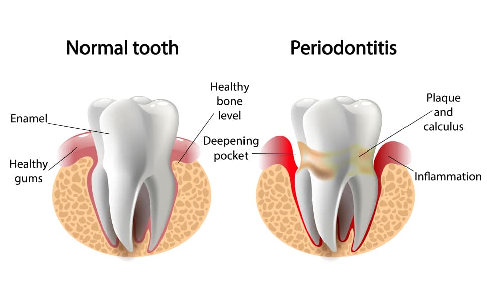 normal tooth vs periodontitis