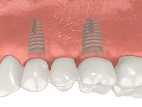 multiple tooth missing teeth with implants seated