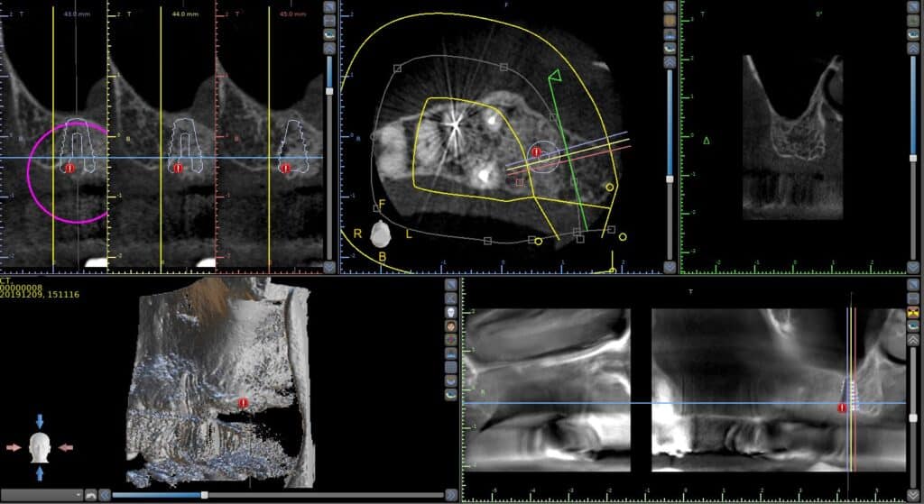 CBCT surgical planning for guided implant surgery