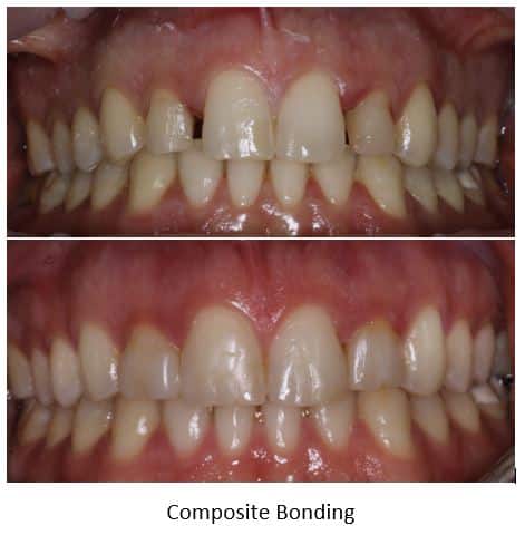 Small lateral incisors enlarged with composite bonding
