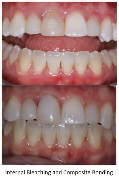Discolored front tooth restored with bleaching and bonding