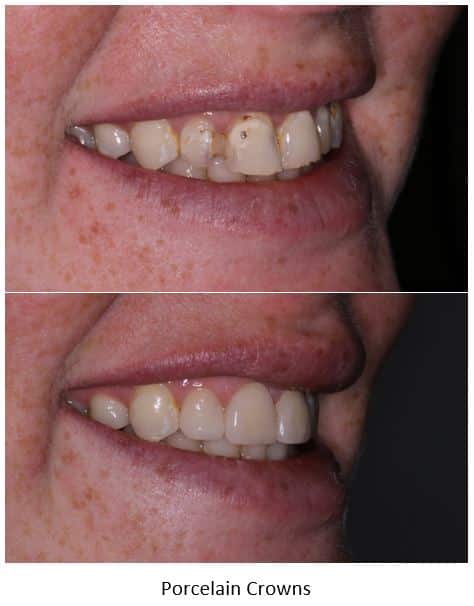 Patient with cavities restored with porcelain crowns