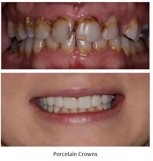 Cavities treated with porcelain crowns