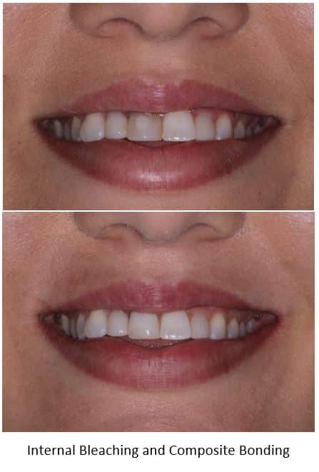 Discolored front tooth restored with internal bleaching and composite bonding