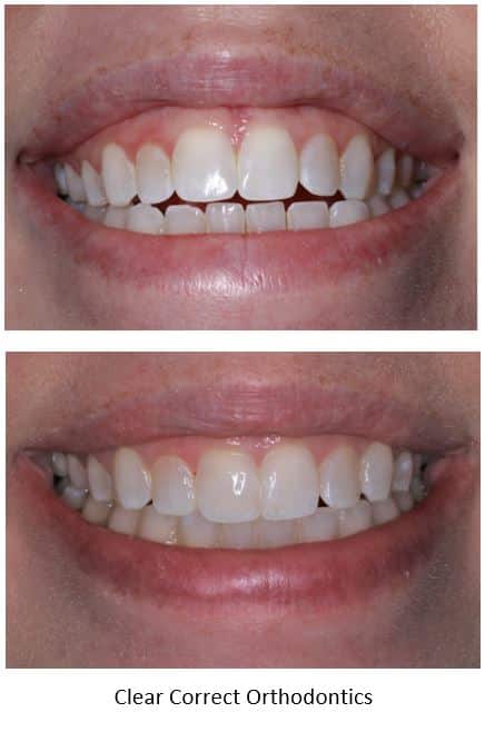 Open bite closed with clear correct aligner orthodontics