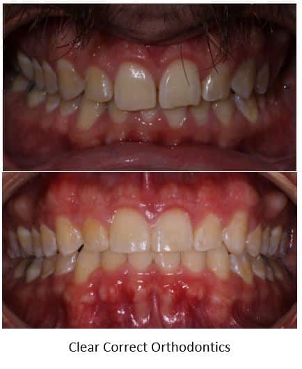 gap between front two teeth closed with clear correct aligner orthodontics