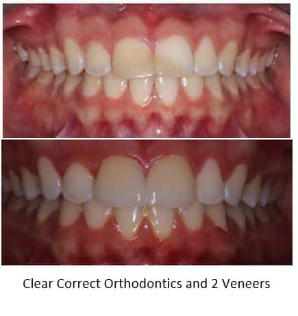 Fractured teeth repaired with discolored bonding replaced with porcelain veneers